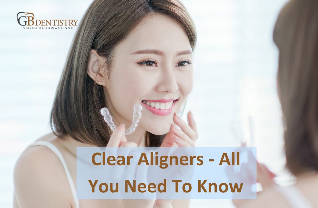 Best Clear Aligners