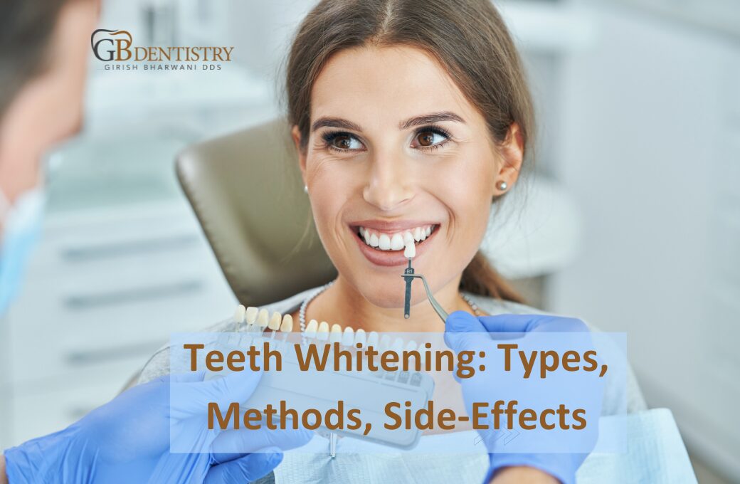 Teeth Whitening: Types, Methods, Side-Effects