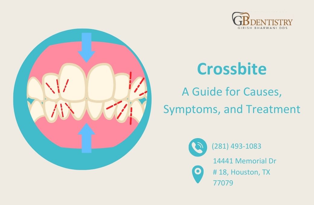 Crossbite – A Guide for Causes, Symptoms, and Treatment