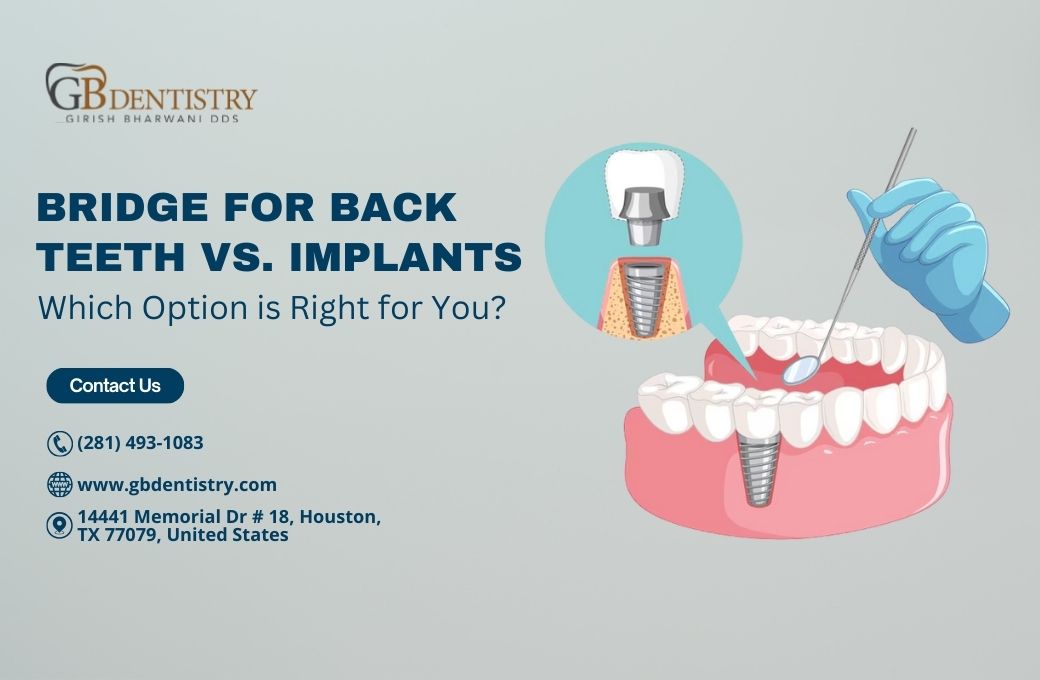 Bridge for Back Teeth vs. Implants: Which Option is Right for You?